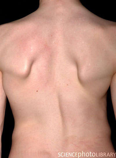 Soto_Syndrome (4).jpg